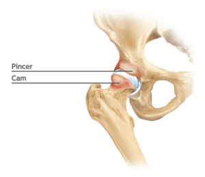 Diagnosing Hip Impingement