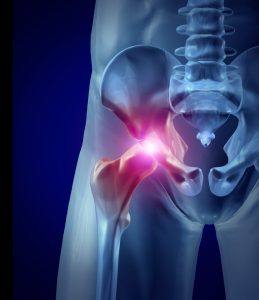 Signs of Hip Osteoarthritis