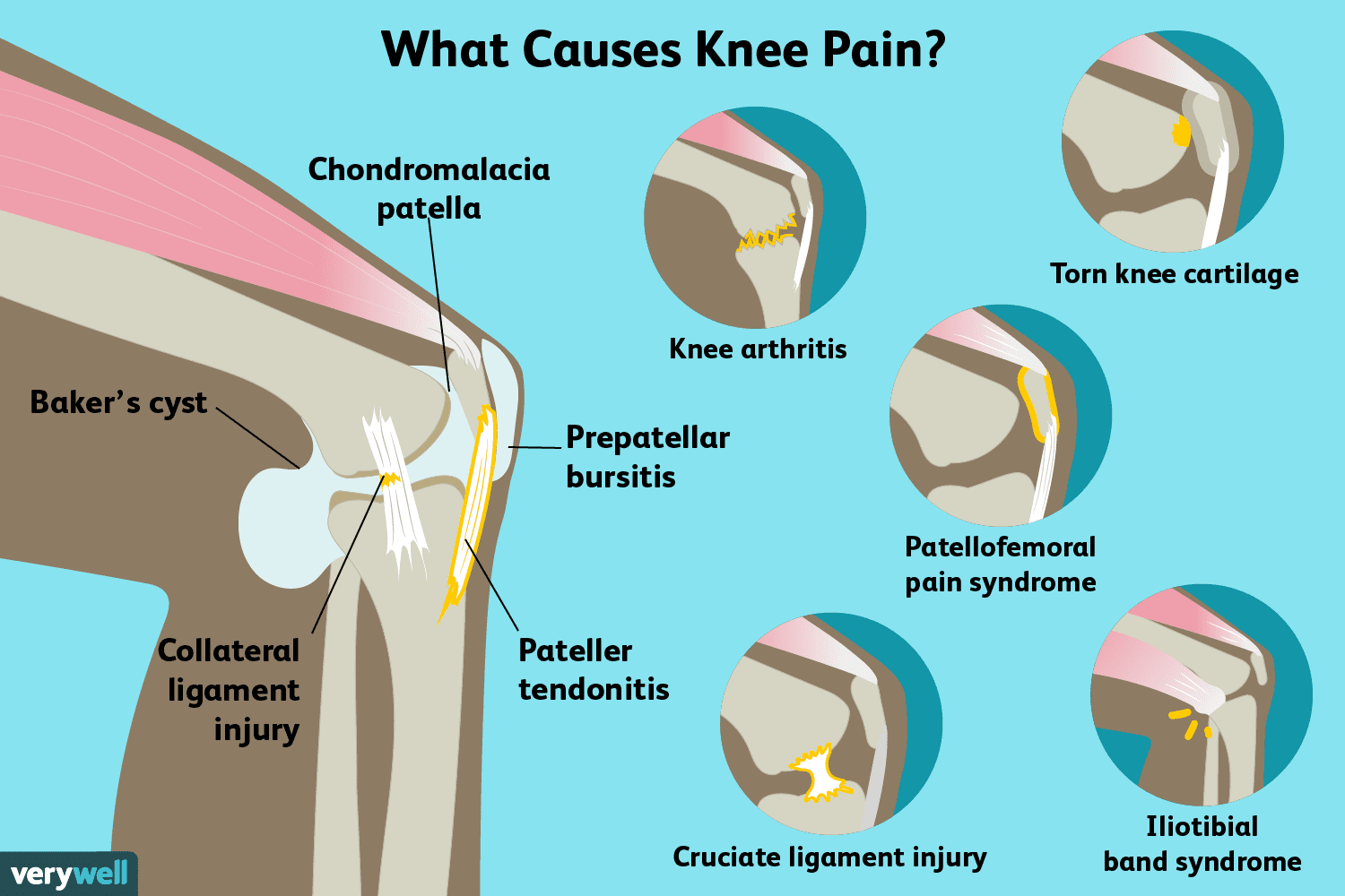 Knee Pain: Top Causes