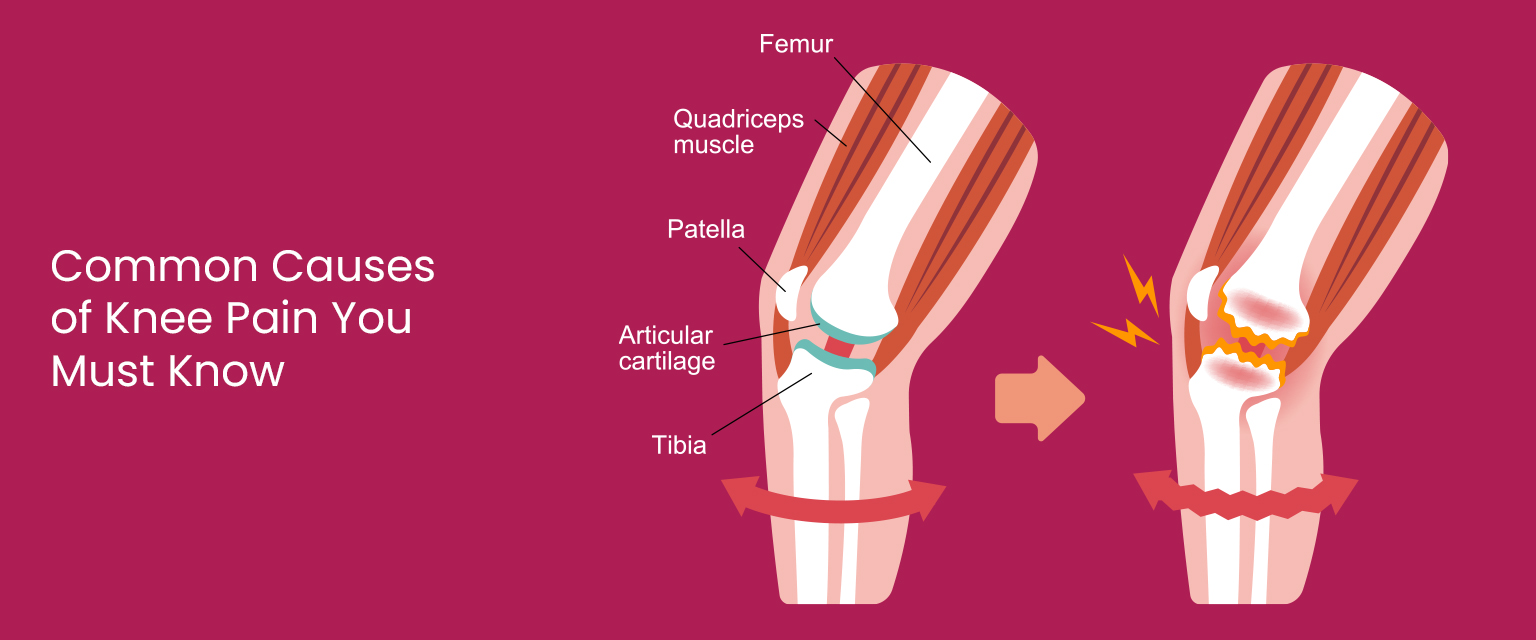 Understanding Knee Pain: Causes