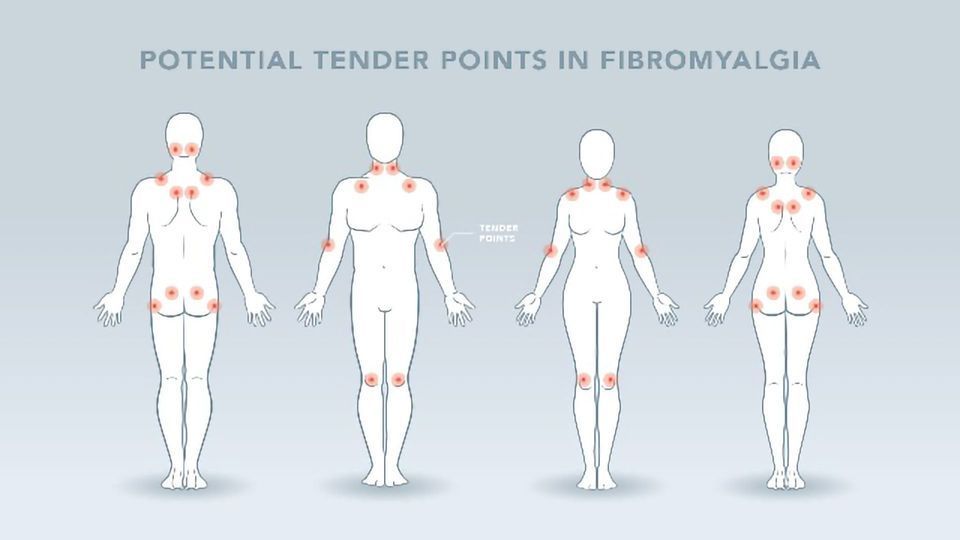 Fibromyalgia vs. General Muscle Pain: How to Know the Difference