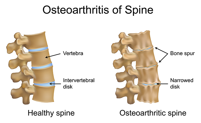 How Aging Affects Your Spine — and What You Can Do About It