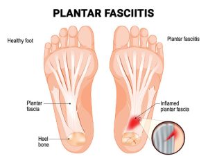 When to See a Podiatrist for Foot Pain