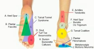 Why Do My Feet Hurt? Common Causes of Foot Pain Explained