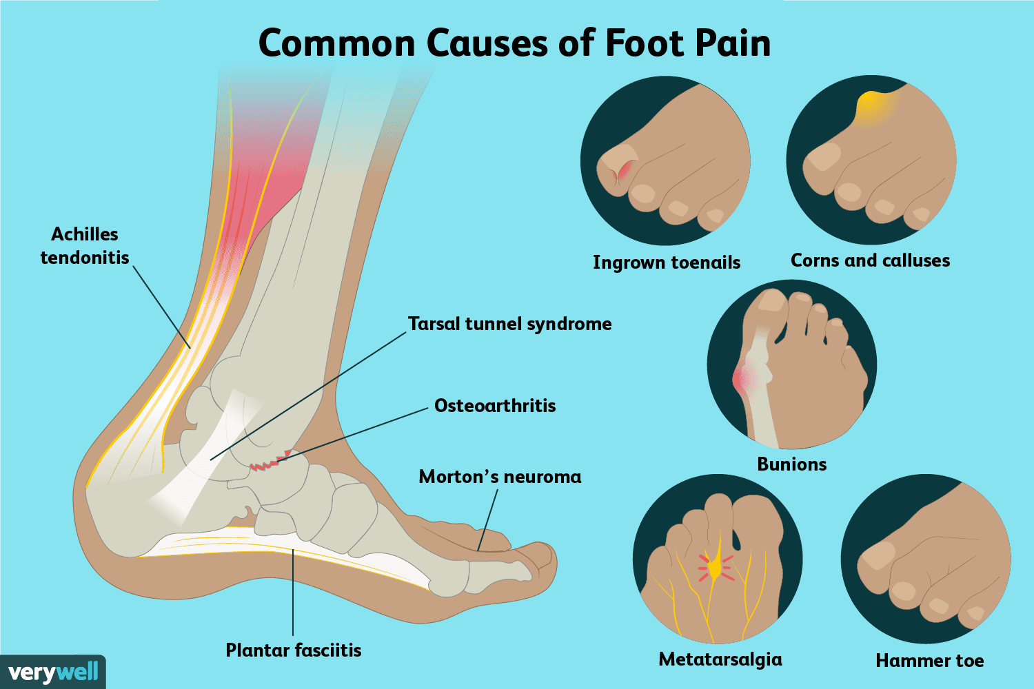 Why Do My Feet Hurt? Common Causes of Foot Pain Explained