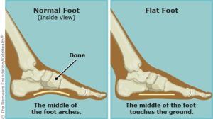 Flat Feet and Foot Pain: What You Need to Know