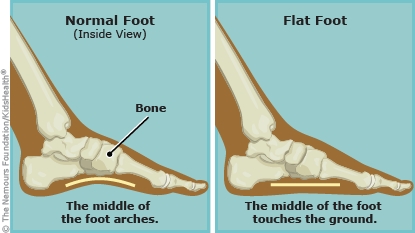 Flat Feet and Foot Pain: What You Need to Know