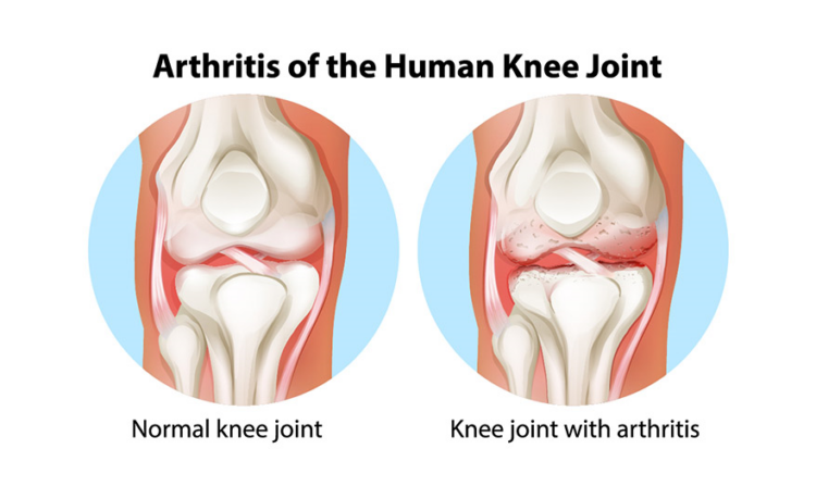 How Joint Pain Develops Over Time