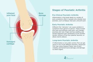 How Joint Pain Develops Over Time