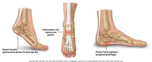 Plantar Fasciitis 101: Symptoms, Causes, and Treatments That Work