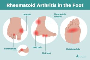 The Most Overlooked Reasons Your Feet Ache Every Day