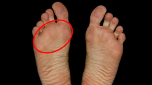 What That Pain in the Ball of Your Foot Really Means