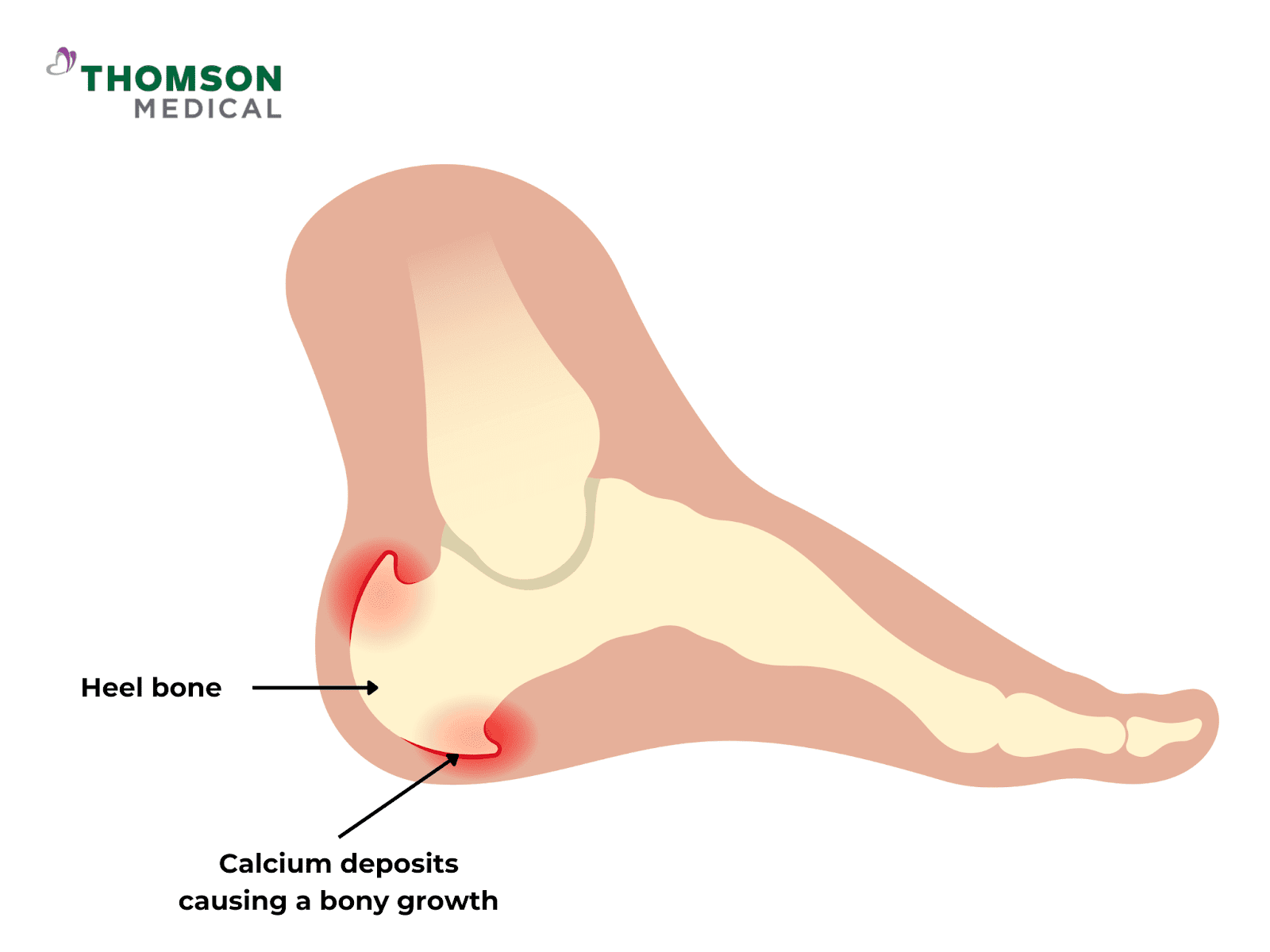 Heel Pain Relief: How to Treat the Most Common Causes