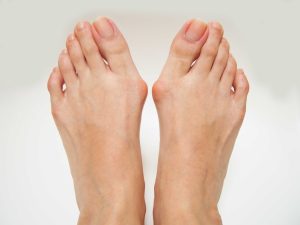 Treating Foot Pain from Flat Feet, Bunions, and High Arches